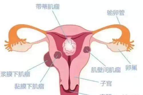 压疮探索之旅，分期、临床表现、护理措施与内心平静的追寻